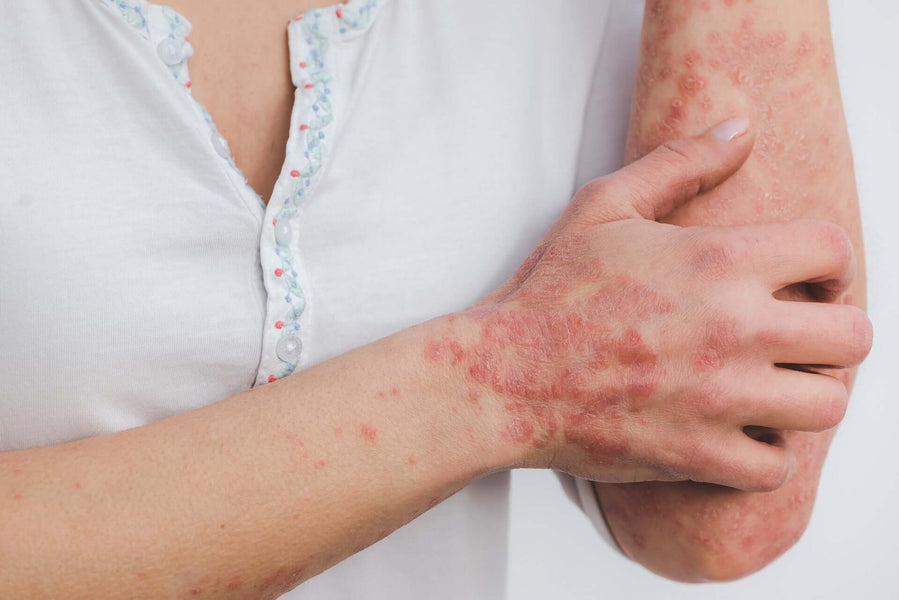 What is Psoriasis?