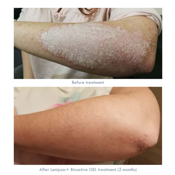 How is Psoriasis treated?